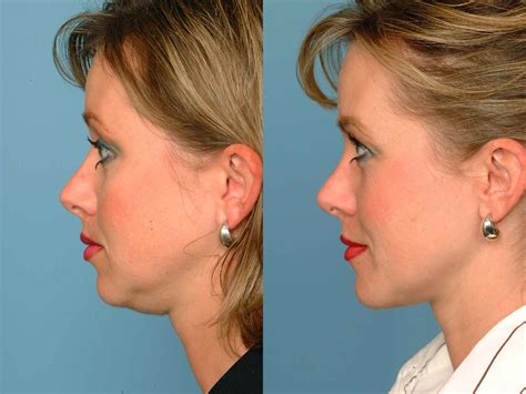 Double Chin Liposuction Price